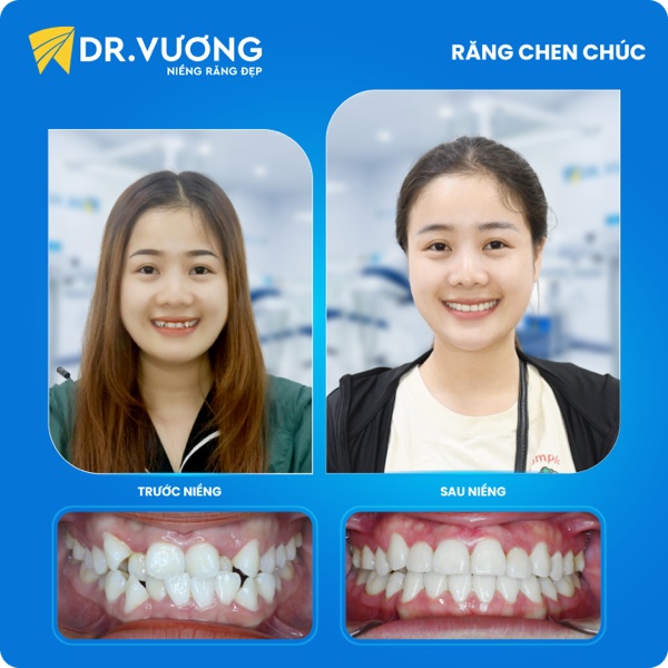 Kết quả 18 tháng điều trị