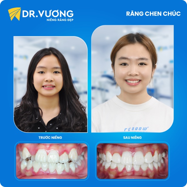 Ca chen chúc nặng