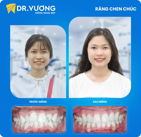 Răng chen chúc — sau niềng