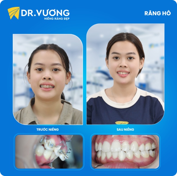 Kết quả mắc cài kim loại