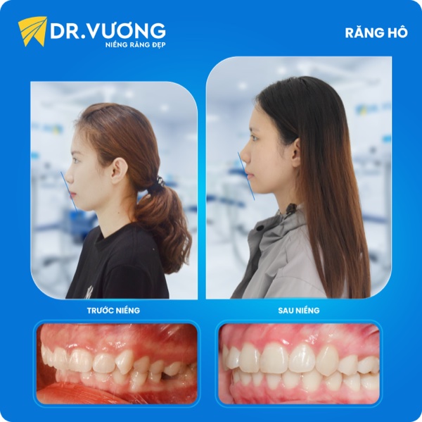Răng hô nặng — sau niềng