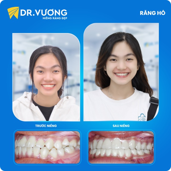Răng hô — sau điều trị