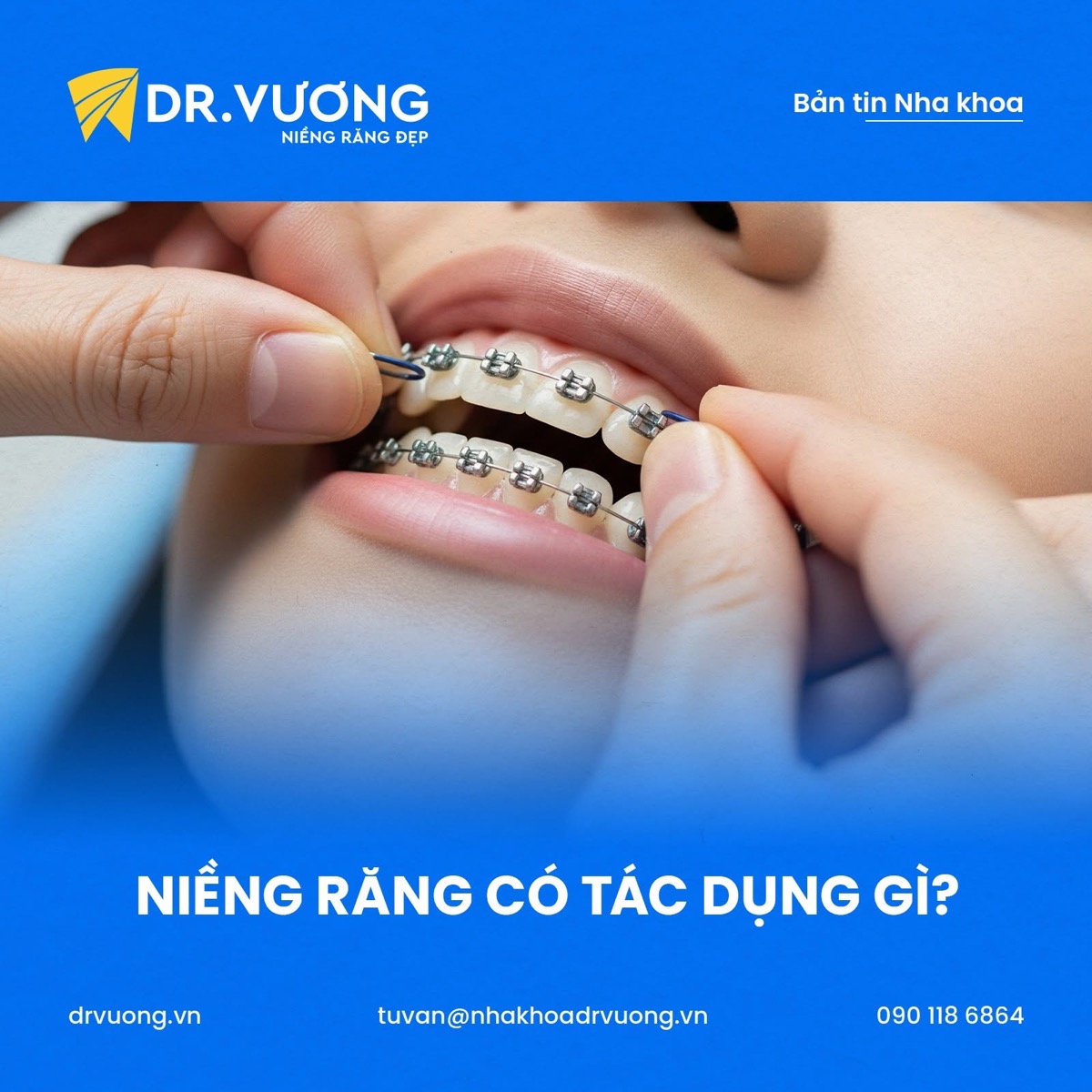Mắc cài kim loại tại Nha khoa Dr. Vương